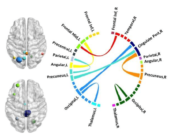 Pathological functional connectivity in children with Childhood Absence Epilepsy using MEG.