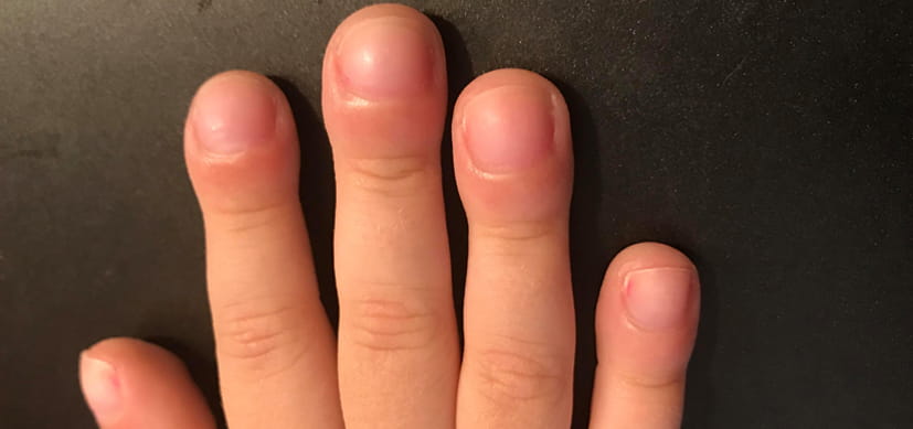 fingers-8x4-1.jpg Aggressive Screening Needed to Detect sJIA Lung Complication