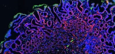 peanut-allergy-8x4-1.jpg Scientists Discover a Peanut Allergy ‘Fingerprint’ That May Help Push Emerging Treatment to New Levels