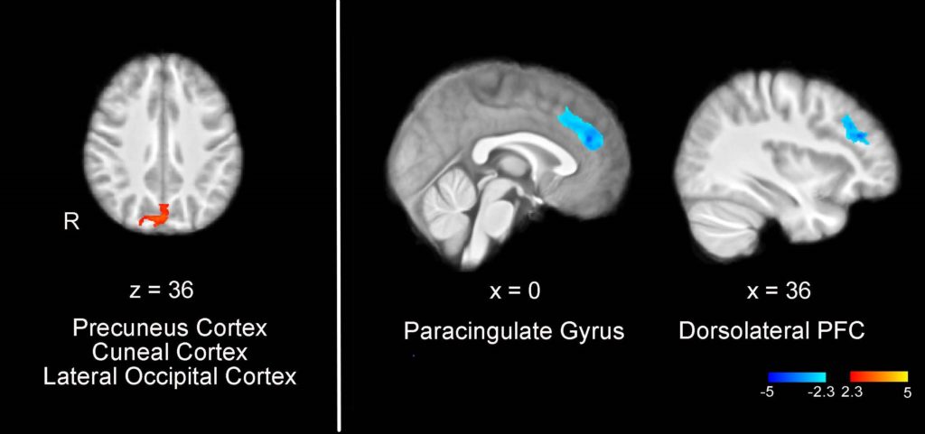 CBT-brain-1024x481.jpg 15-Site Trial to Compare Telehealth Cognitive Behavior Therapy Alone and with Medication to Prevent Migraine in Youth