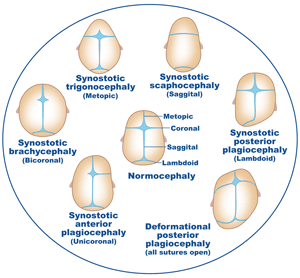 sagittal synostosis symptoms