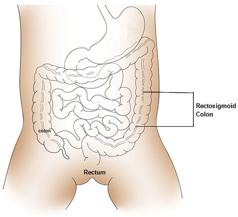 Fecal incontinence or Bowel Incontinence products for bowel leakage or loss  of bowel control –