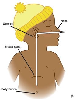 Inserting a Silastic Nasogastric Feeding Tube?