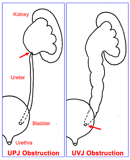 Hydronephrosis | Symptoms, Diagnosis & Treatment