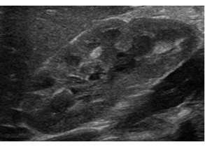 Ultrasound of a normal kidney