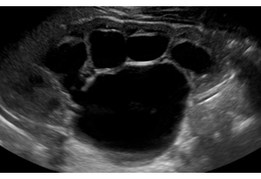 severe hydronephrosis kidney