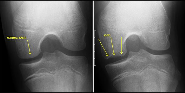 This is a photo of Osteochondritis Dissecans