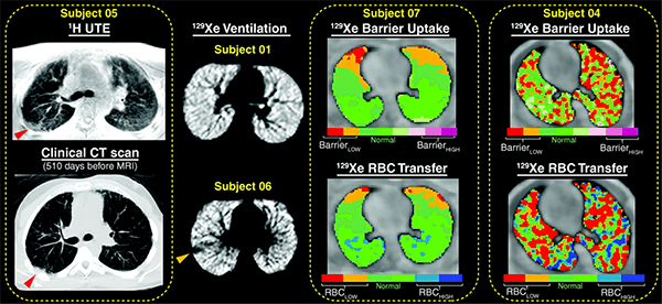 An image of 1H and xenon 129 (129Xe) MRI findings.