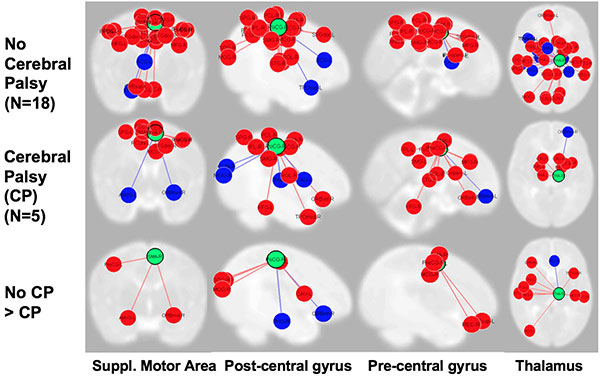 functional-connectivity-MRI-cerebral-palsy