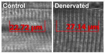 Figure 1 - Impaired longitudinal growth of muscle is indicated by overstretched sarcomeres at fixed joint angles, indicating fewer than normal sarcomeres in series within denervated muscle.