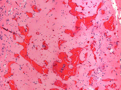 Diesel exhaust particles in macrophage.
