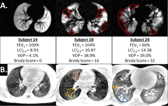 Example image slices for 129Xe (a.) and UTE (b.) images in CF subjects.
