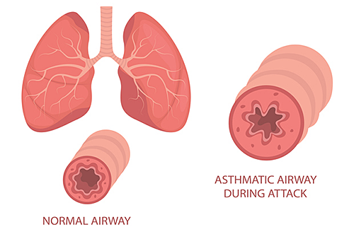 Cincinnati Children's researchers are studying the connections between asthma and eczema. 