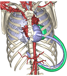 Fit Study Syncardia.