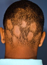 alopecia areata