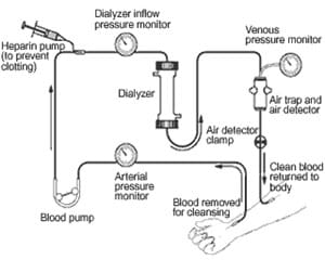 hemodialysis diagram