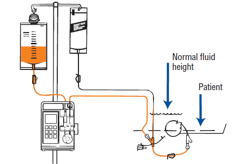 Nasogastric Tube Feeding Using a Feeding Pump