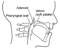 Velopharyngeal Dysfunction | Insufficiency, Incompetence & Mislearning