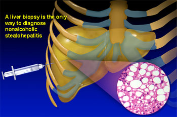 Biopsies are the best way to diagnose.